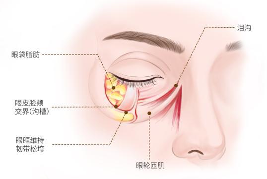 然衰老的标志去除眼袋焕发青春光彩九游会真人游戏第一品牌眼袋不是自(图1)